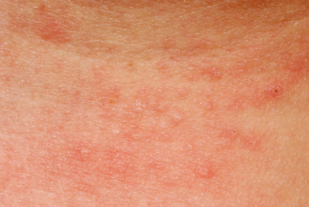 ALLERGY AND SKIN. WHAT TO DO, THE TYPES AND CAUSES. - Twinkle Thomas ...