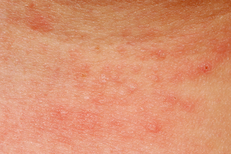 Skin Allergy Symptoms Of Covid